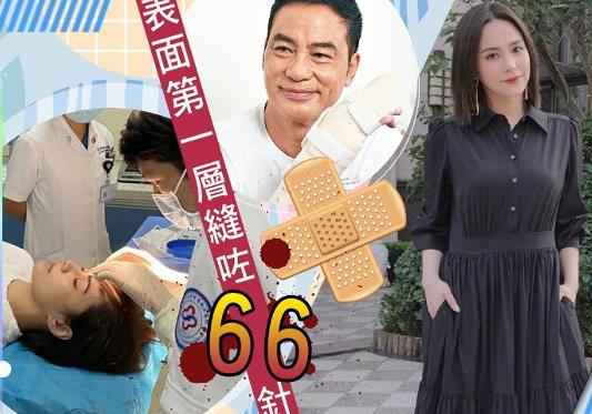 阿娇头部外貌一层已缝66针 由顶级整容科院长拆线后从头缝针