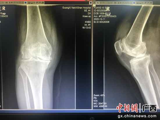 膝枢纽置换术乐成办理81岁老人多年困扰