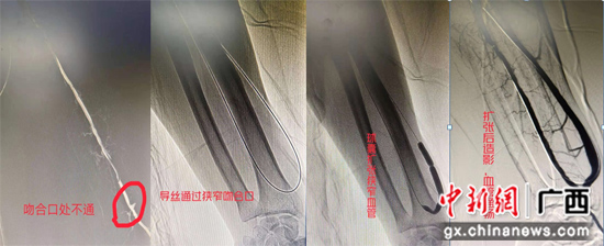 小小球囊还血液透析患者通畅“生命线”