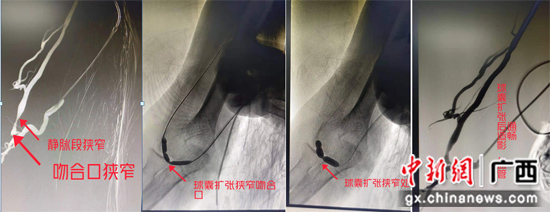 小小球囊还血液透析患者通畅“生命线”