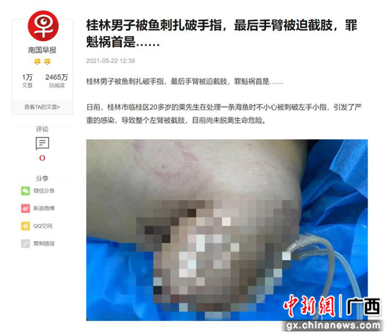 鱼刺扎伤效果严重 学科相助凸显神效