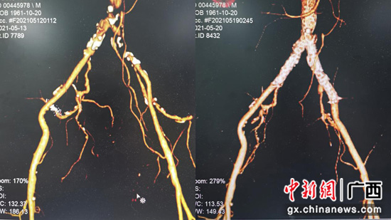 老兵下肢动脉硬化闭塞 医生“两针眼”微创解难题