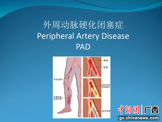 老兵下肢动脉硬化闭塞 医生“两针眼”微创解难题