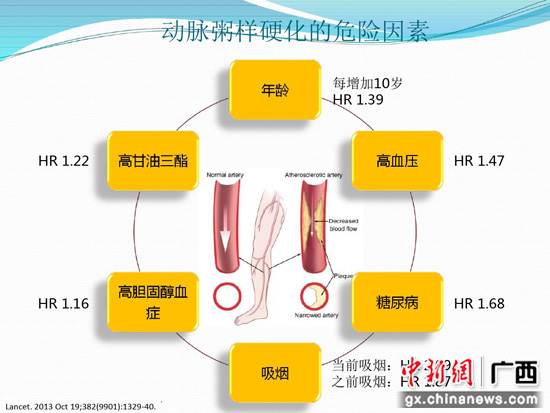 老兵下肢动脉硬化闭塞 医生“两针眼”微创解难题