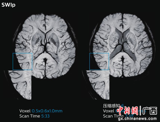 南溪山医院高端科研型磁共振Ingenia 3.0T CX正式投用