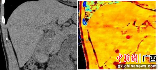 广西首台彩色光谱CT在南溪山医院投入使用