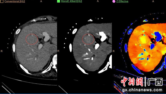 广西首台彩色光谱CT在南溪山医院投入使用